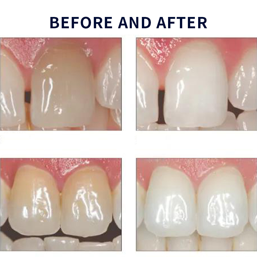 Отбеливающий набор opalution 2 – обзор и цена Teeth Whitening Q&M