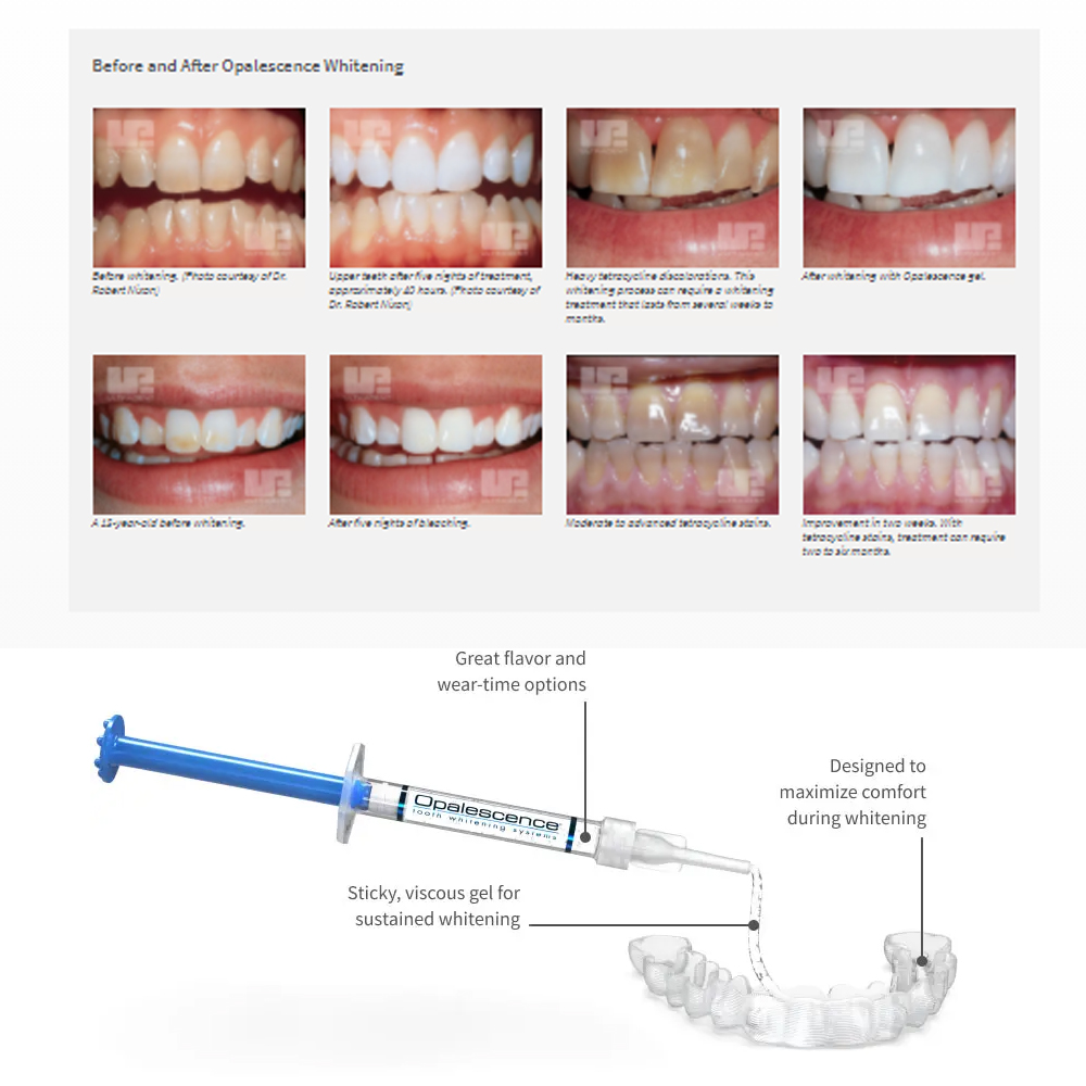 Отбеливающий набор opalution 2 – обзор и цена Teeth Whitening Q&M