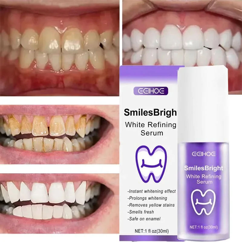 Очищение зубов, отбеливающая з – обзор и цена Teeth Whitening In Korea