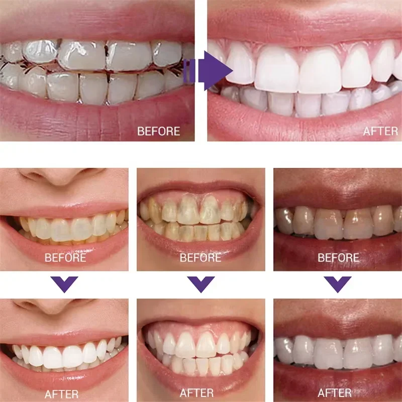 Очищение зубов, отбеливающая з – обзор и цена Teeth Whitening In Korea