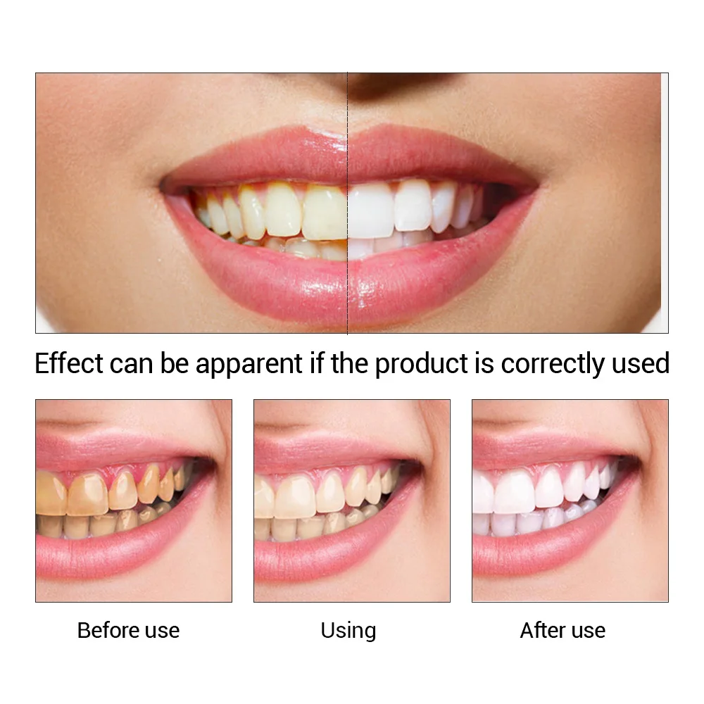 FTEENPLY отбеливание зубов быс – обзор и цена Teeth Whitening Treatment
