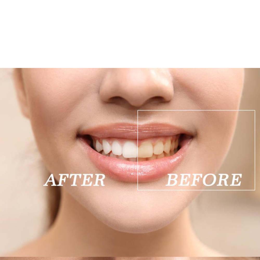 Высокое качество пероксид отбе – обзор и цена Teeth Whitening (Bleaching)